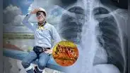 ¿Qué es el derrame pleural?: La complicación por dengue que acabó con la vida del 'Ingeniero Bailarín' a sus 34 años