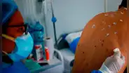 Minsa reporta primer caso de viruela del mono en Huancayo: Hospital Carrión activa triaje especialista