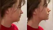 ¿Qué es el 'mewing'? El ejercicio viral de TikTok que promete transformar el rostro: elimina la papada y afina la mandíbula