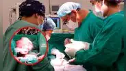Piura: médicos de Chulucanas extraen tumor de 5 kilos del útero de una paciente de 46 años