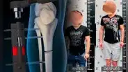 Así es la cirugía extrema para ser más alto: "Te rompen los huesos de las piernas para crecer hasta 15 centímetros"
