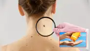 ¿Cómo proteger tu piel del sol y reducir el riesgo de cáncer? Dermatóloga peruana te brinda sus mejores recomendaciones