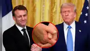 Donald Trump fue visto con hematomas en reunión con Macron en la Casa Blanca: ¿a qué se debe esta lesión?