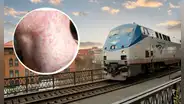 Alerta en Nueva York: reportan que una persona infectada con el virus del sarampión viajó en el tren Amtrak