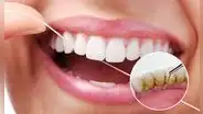 ¿Tienes sarro en los dientes? Este remedio casero puede ayudarte a eliminarlo rápidamente según dentistas