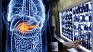 Científicos chinos logran detectar cáncer de páncreas con inteligencia artificial y recibe aprobación de la FDA