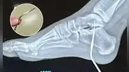 Niña sufre grave accidente al clavarse aguja de crochet de 10 cm en el pie: médicos en California "no podían creer lo que veían"