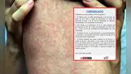 Minsa emite alerta epidemiológica por caso importado de sarampión desde Estados Unidos