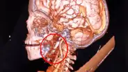 Niño de 7 años sobrevive a un terrible accidente en la India: un clavo de 3 pulgadas se incrustó en su cerebro