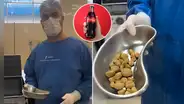 Médicos extraen 35 piedras renales a un hombre en Brasil que tomó hasta 3 litros de Coca-Cola al día durante años