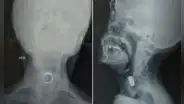 Mujer de 85 años comió un anillo mientras dormía: soñó que era caramelo y terminó internada en hospital de Lima