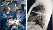 El increíble caso del hombre que vivió 8 años con un cuchillo en el pecho sin saberlo: médicos lo descubrieron tras una infección