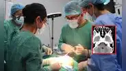 Médicos salvan la vida de un niño que llegó de Jaén a Lima porque tenía una piedra incrustada en el cráneo