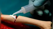 Científicos chinos crean un pegamento para huesos que repara fracturas en solo tres minutos de forma rápida y segura
