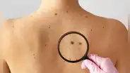 Las recomendaciones del Minsa para la detección temprana de lunares sospechosos y descartar cáncer de piel