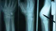Estudio científico descubre proteína clave para la reparación de huesos después de sufrir una fractura