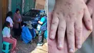 Brote de sarampión: casos se cuadruplican en solo tres días durante alerta sanitaria en Puno