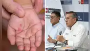 ¿Cerrarán colegios por virus Coxsackie? Esto dijo el Minedu ante el aumento de contagios en Lima y regiones