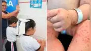Aumenta a 1.658 los contagios por virus Coxsackie en el Perú, según Minsa: Lambayeque registra 300 casos en 50 colegios
