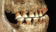 Un diente con un agujero revela que los neandertales practicaban la odontología con éxito usando ‘taladros’ de piedra