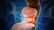Ensayo clínico internacional demuestra eficacia de terapia combinada en cáncer de próstata agresivo: menos progresión y menor mortalidad