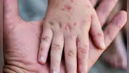 Amplían por 90 días emergencia sanitaria por brote de sarampión y riesgo de contagio en 11 regiones
