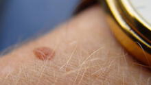 Día del Lunar: ¿cómo detectar y prevenir a tiempo las inusuales manchas en la piel? 