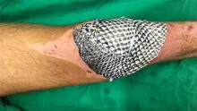 Tilapia: el pez cuya piel puede curar quemaduras y reconstruir vaginas [VIDEO]