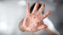 Más de 22 millones de bebés no se vacunaron contra el sarampión durante la pandemia de la Covid-19