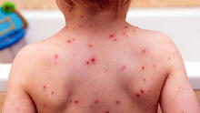 ¿Cuáles son los mitos y verdades sobre la varicela?