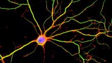 Identifican las neuronas claves que mueren durante la enfermedad del párkinson