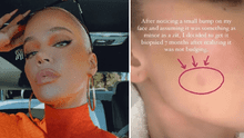 Khloé Kardashian revela que le extirparon un tumor del rostro tras sufrir cáncer de piel