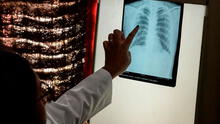 La tuberculosis vuelve a propagarse en todo el mundo, advierte la OMS