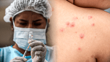 Viruela del mono: Minsa recibe primer lote de vacunas contra esta enfermedad