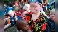 Vivir con miedo: niños y adultos albinos en África son asesinados para el tráfico de órganos