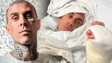 Travis Barker de Blink-182 tras cirugía en su dedo: "Fue un éxito, seguiré haciendo lo que me gusta"