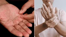 ¿Por qué se nos pelan las manos, cómo evitarlo y cuándo es peligroso?