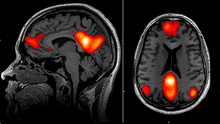 Inteligencia artificial puede detectar el Parkinson años antes de que aparezcan los síntomas