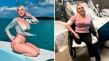 Modelo sufre amputación de una pierna tras contraer letal bacteria en sus vacaciones en Bahamas