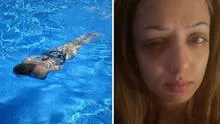 Mujer acudió a nadar a piscina pública y perdió la visión en un ojo: “El dolor más insoportable”