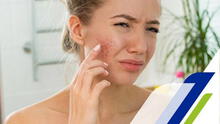 ¿Qué secuelas deja el acné tras el verano intenso?