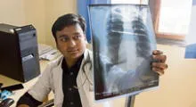 Cada año se reportan 30 mil casos de tuberculosis en el Perú