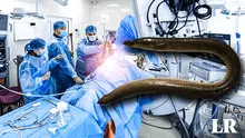 Encuentran una anguila de 30 cm viva en el estómago de un hombre: se introdujo por su recto