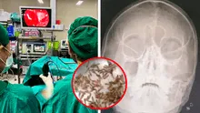 Mujer descubre 100 larvas dentro de su nariz cuando pensaba que tenía una simple congestión nasal