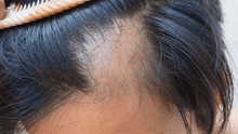 Investigadores de Harvard logran revertir la pérdida de cabello causada por la alopecia