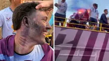 Oliver Sonne recibió impacto de bengala en el rostro cuando festejaba ascenso de Burnley y casi es quemado