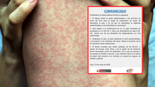 Minsa emite alerta epidemiológica por caso importado de sarampión desde Estados Unidos
