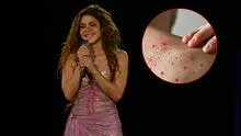 Nueva Jersey lanza alerta sanitaria tras un posible contagio masivo de sarampión en concierto de Shakira Nueva Jersey lanza alerta sanitaria tras un posible contagio masivo de sarampión en concierto de Shakira