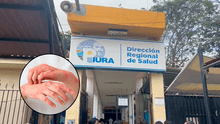 Lepra en Piura: Dirección Regional de Salud reporta el primer caso del 2025
