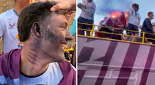 Oliver Sonne recibió impacto de bengala en el rostro cuando festejaba ascenso de Burnley y casi es quemado